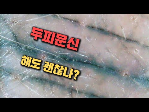 헤어라인 두피문신 SMP 과연 효과는? 부작용은?