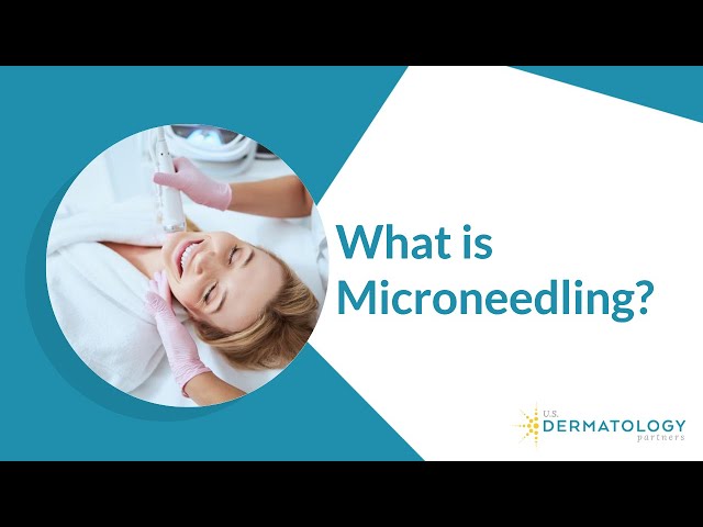 Video Pronunciation of needling in English