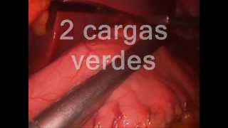 Gastrectomía tubular laparoscópica - Dr. Mena del Río. Cirugía de la obesidad