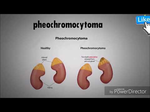 Power-Modus und für hypertensive Krise Hypertonie Behandlung im Ausland