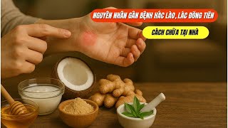 Làm Thế Nào Để Chữa Bệnh Hắc Lào An Toàn - Hướng Dẫn Từ Chuyên Gia