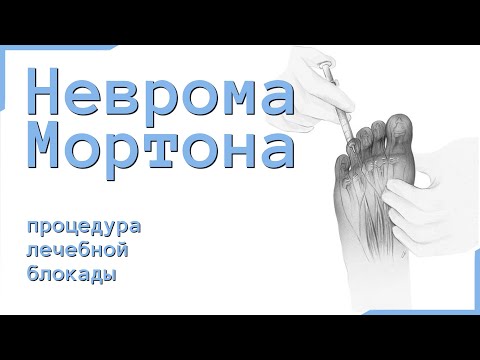 Wrodzona deformacja zatrzymać Jak radzić sobie z guzem na palucha