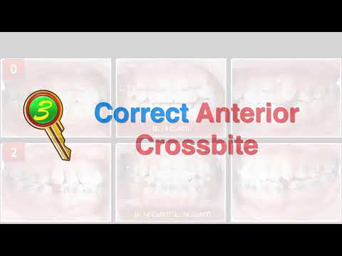 Treatment of Skeletal Class I with Anterior Crossbite and Crowding｜【Chris Chang Ortho】CC786