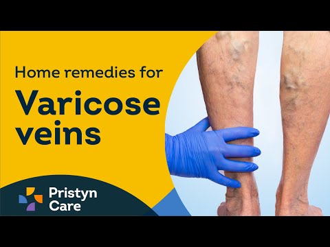 Home remedies for varicose veins