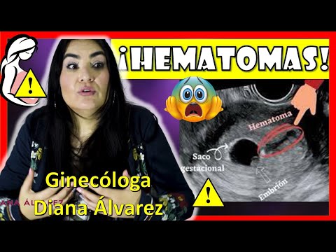 HEMaTOMAs en el EMBARAZO, SANGRaDOs PRiMER y SEGuNDO TRiMESTRE, por GINECOLOGA DIANA ALVAREZ