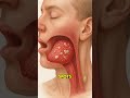 5 Warning Signs Of Tonsillitis You Shouldn T Ignore