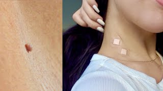 HOW TO REMOVE SKIN TAGS OVERNIGHT & NATURALLY | DIY (Easy At Home Mole Removal) 100% Works!