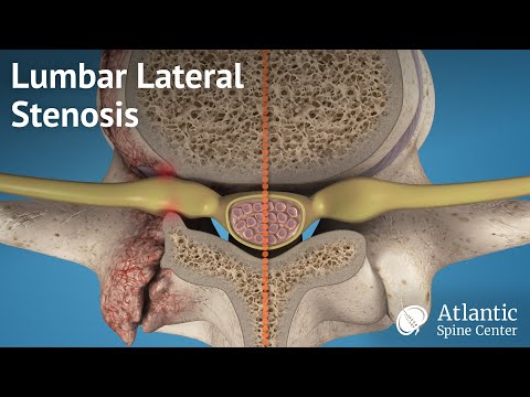 Lumbar Lateral Stenosis Anatomy