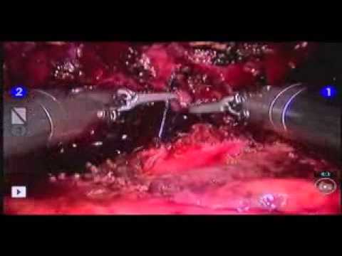 Nerve Sparing Robotic Prostatectomy