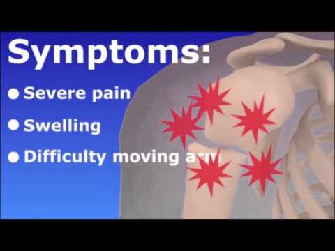 Humerus Fracture - Broken Upper Arm