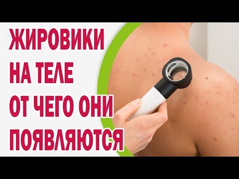 Жировики на теле: от чего они появляются
