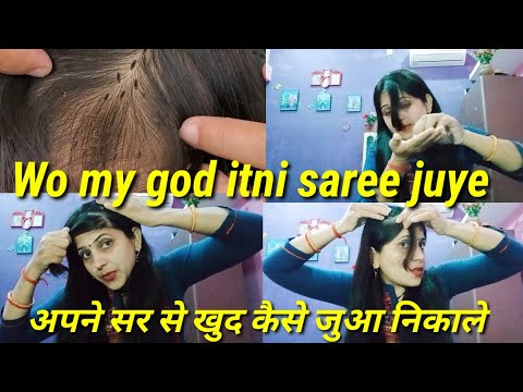 Remove many lice from brown hair- plucking most of lice from head अपने सर से कैसे जुये निकालती हूं😱