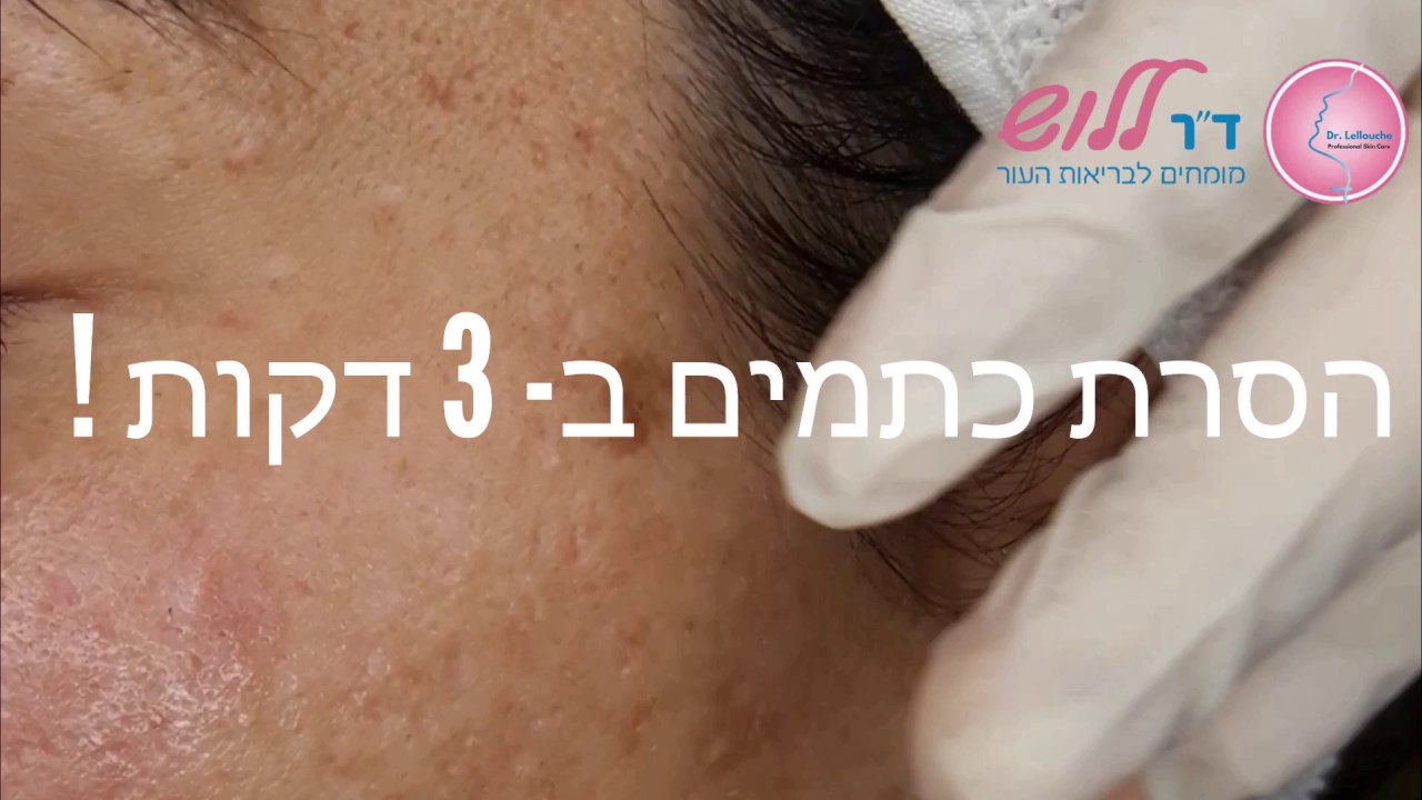 פיגמנטציה: הסרת כתמי שמש ב- 5 דקות !