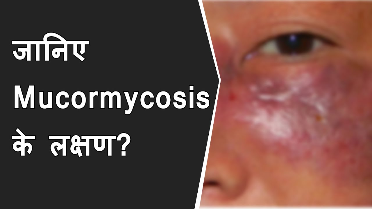 Mucormycosis Symptoms | 6 common symptoms of Mucormycosis | Dr. Randeep Guleria | Mucormycosis news
