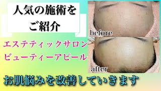 【フェイシャルエステ】ビューティーアピール人気コース