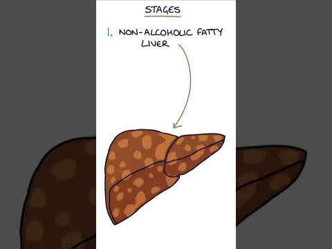 Primary Sclerosing Cholangitis Visual Explanation for Students