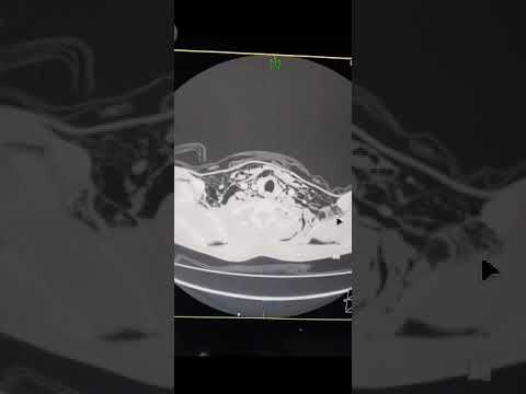 Case 11: Surgical emphysema - diffuse case, CT