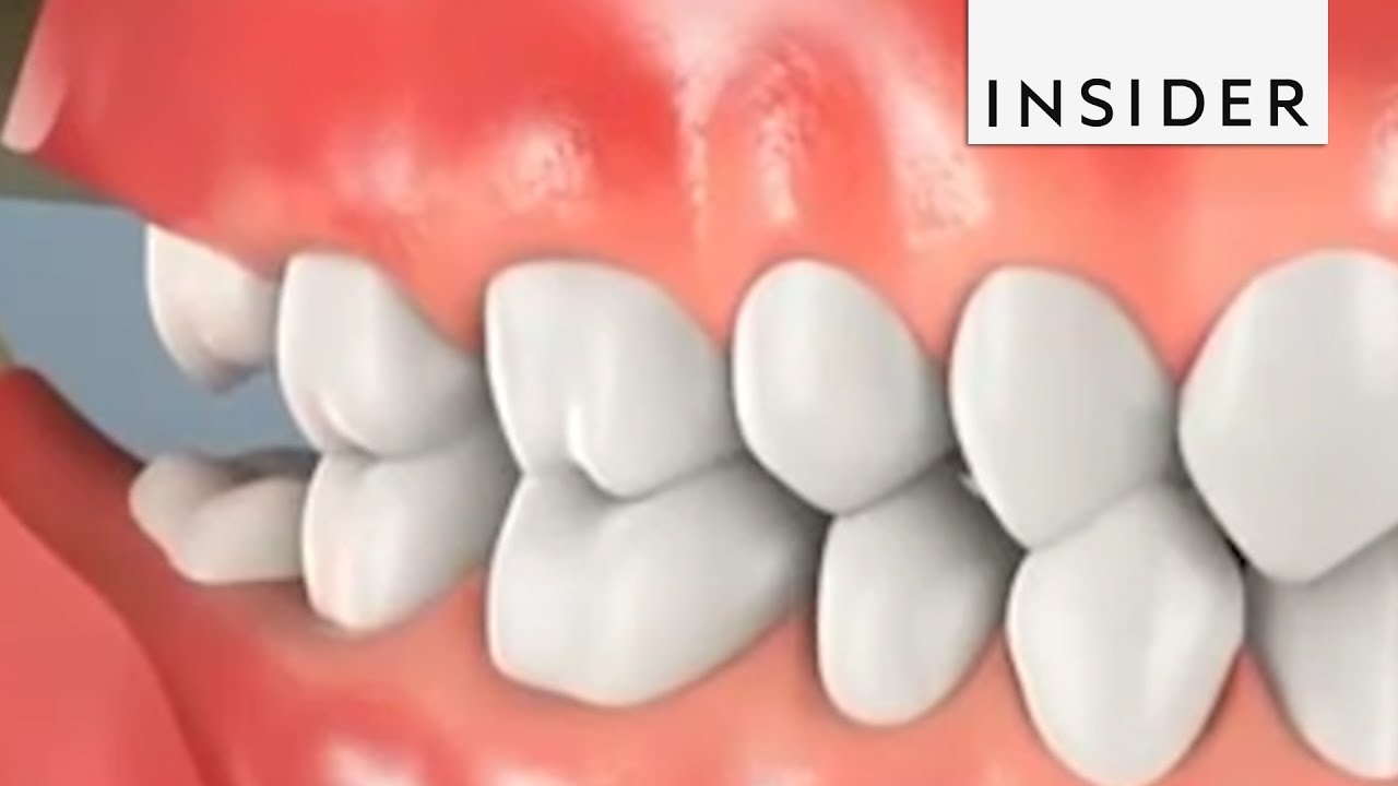 Why Do We Remove Wisdom Teeth? - YouTube