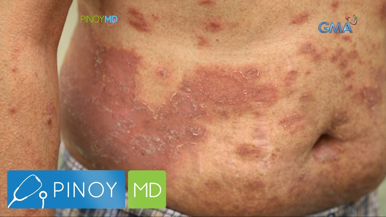 Pinoy MD: Ano nga ba ang Psoriasis