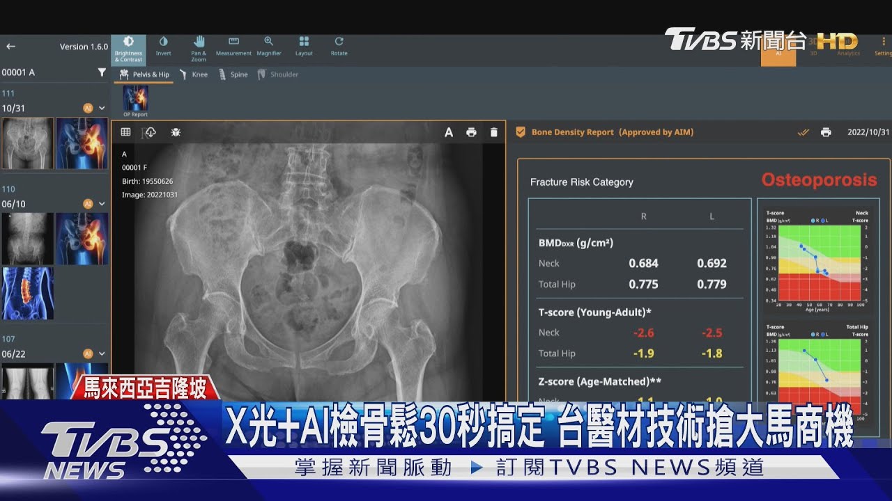 搶台馬「345億美元」商機!台醫療軟體AI測骨鬆