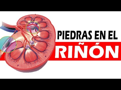 Remedios caseros para eliminar las piedras en el riñón