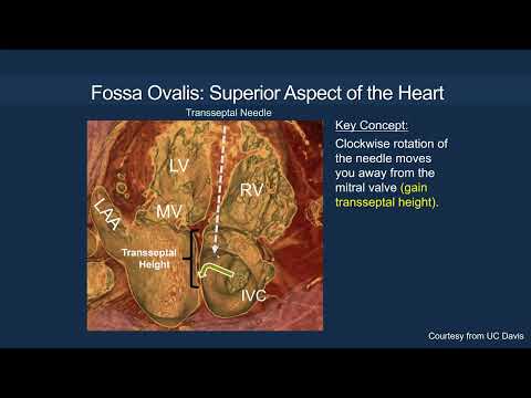 Transseptal Access Fundamentals
