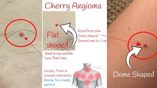 Cherry angioma - Red moles on skin