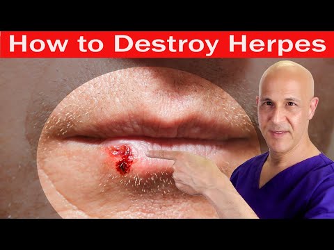How to Destroy HERPES | Dr. Mandell