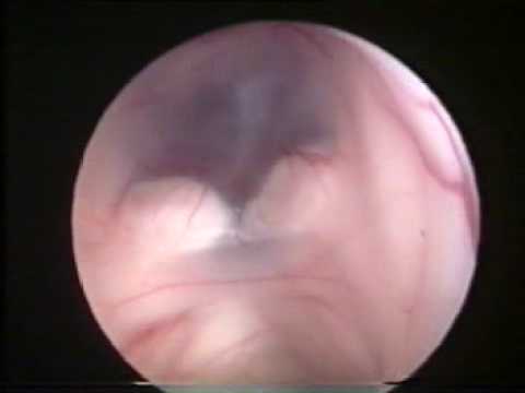 Drainage Of the Third Ventricle Using Endoscopic Method