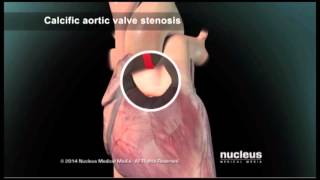 Transcatheter Aortic Valve Implanation