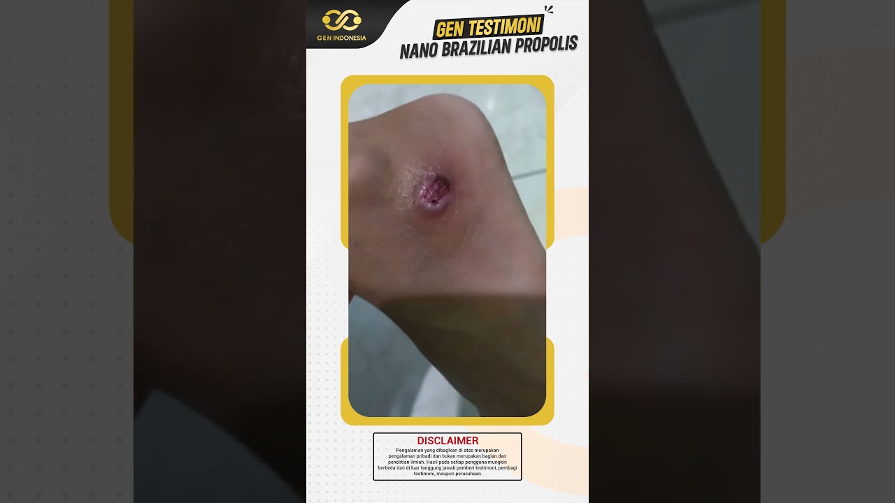 Luka basah langsung kering