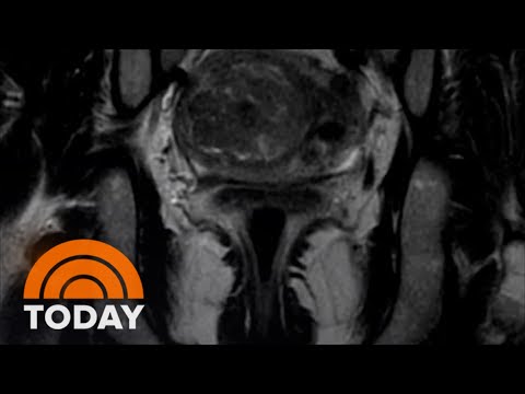 Doctor Breaks Down What Women Need To Know About Fibroids