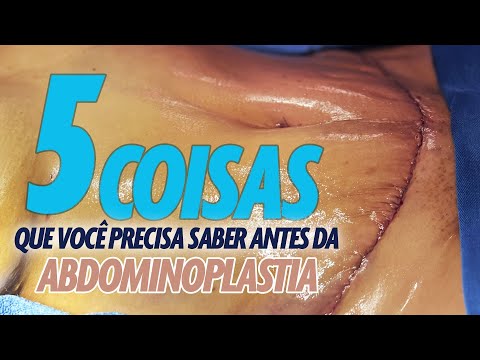5 COISAS QUE VOCÊ PRECISA SABER ANTES DE FAZER ABDOMINOPLASTIA? CIRURGIA PLASTICA