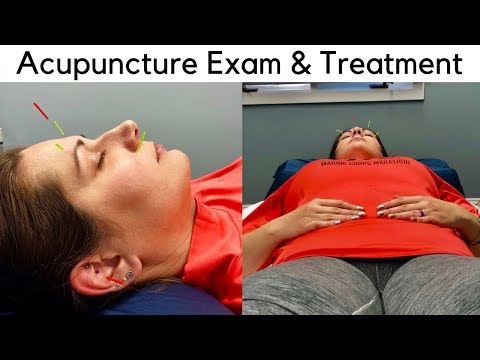 Acupuncture in Burke, VA - Acupuncture Examination and Treatment