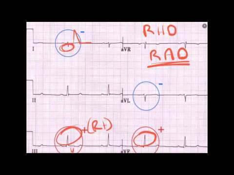 ECG in PE - A Primer