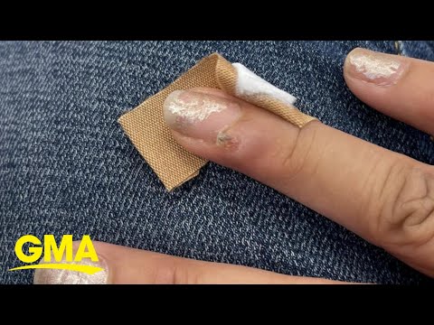 Woman claims she got HPV-related nail cancer after...