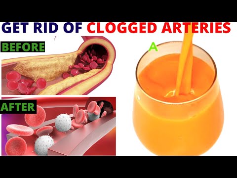 Strong Drink To Unclog Arteries & Heart: 1 Glass In The Morning Will Be Amazing - (Plaque Removal)