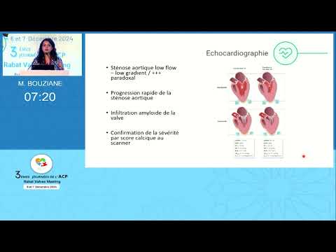 Sténose aortique et Amylose 