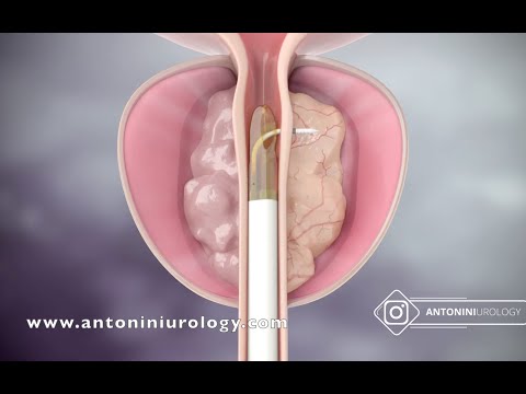 Prostatitis a szájban