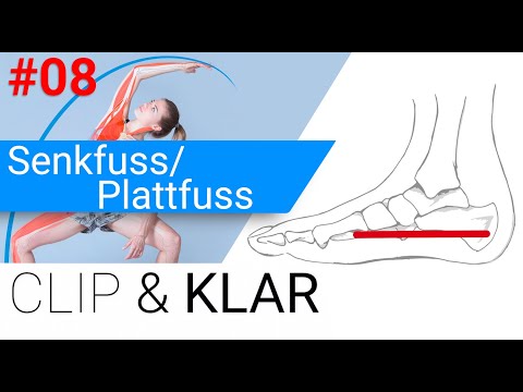 Senkfuss/Plattfuss erklärt - Gewölbekollaps in Zeitlupe