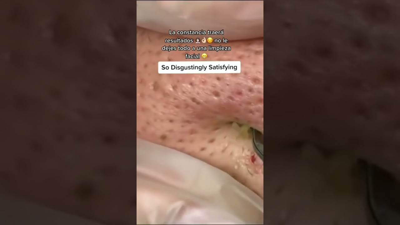 Watch Que hacer después de una limpieza facial para mantener el efecto 👩🏻⚕️ Now Que hacer después de una limpieza facial para mantener el efecto 👩🏻⚕️