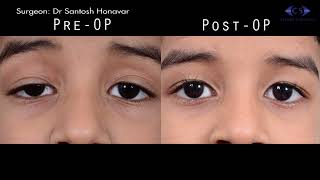 Ptosis Correction by Tarsofrontal Sling Using Silicone