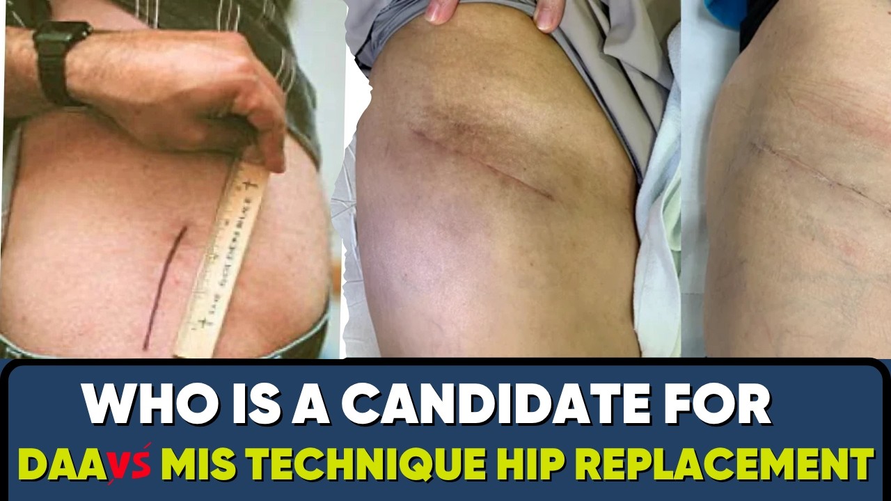 DAA(Direct Anterior Hip Replacement)-who's ideal candidate? #directanteriorapproach #hipreplacement