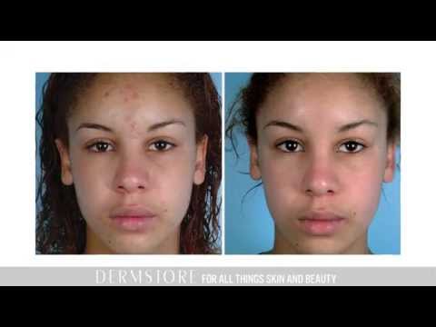 At Home Microdermabrasion with PMD Personal MicroDerm