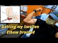 Getting my Swollen Elbow Drained