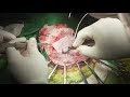 Video Operasi - Suturectomy #1