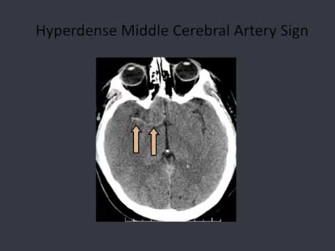 BATs: Assessment of Acute Stroke