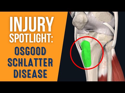 What is Osgood-Schlatter Disease?