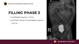 Core Videos (2025): POSTERIOR URETHRAL VALVE – VOIDING CYSTOURETHROGRAM