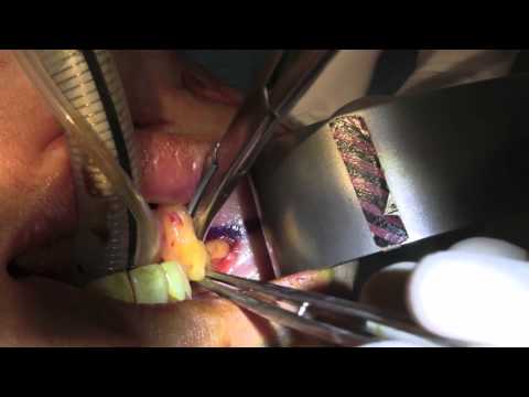 Buccal Fat Excision